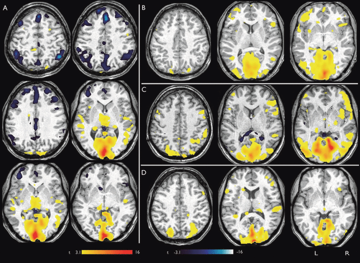 fMRI images